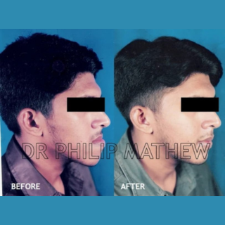 Orthognathic Surgery