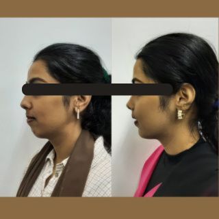 Orthognathic Surgery