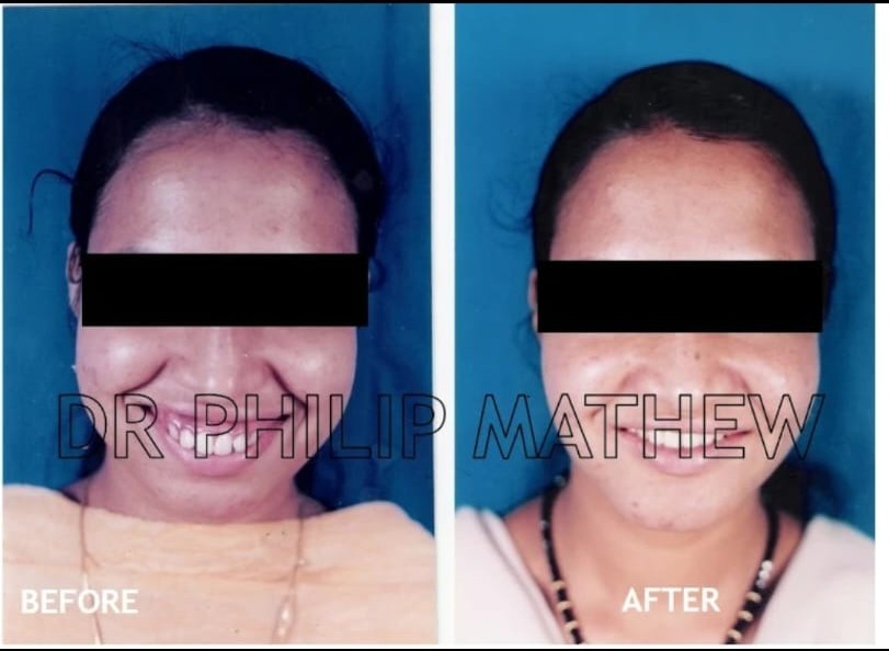 Orthognathic Surgery