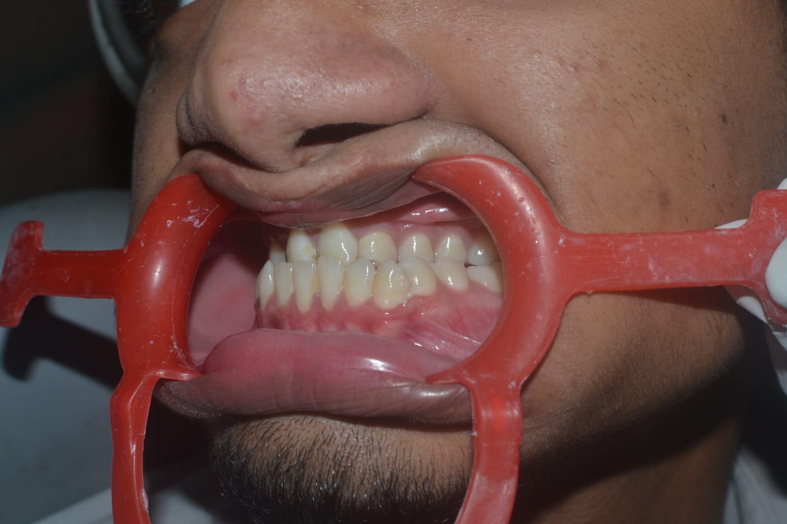 Orthognathic Surgery