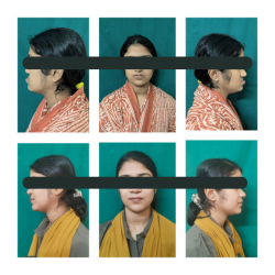 Orthognathic Surgery