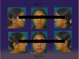 Cleft lip and Palate Treatment