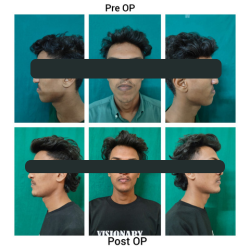 Orthognathic Surgery